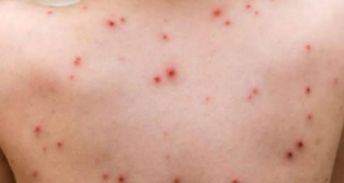 Registra Veracruz 47 casos de sarampión de acuerdo al reporte de Salud Federal