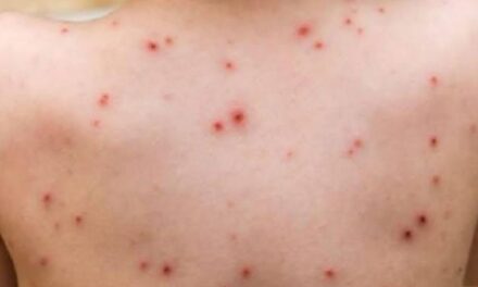 Registra Veracruz 47 casos de sarampión de acuerdo al reporte de Salud Federal