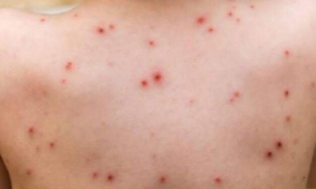 Registra Veracruz 47 casos de sarampión de acuerdo al reporte de Salud Federal